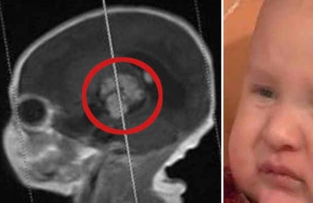 Sam Esquibel hat durch fetale Inklusion einen Fuß im Gehirn